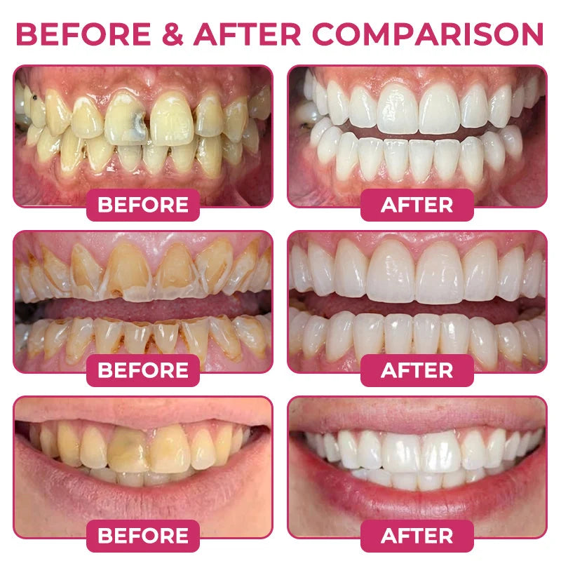 DenPerm Cavity-Repair Natural Enamel Filling Gel